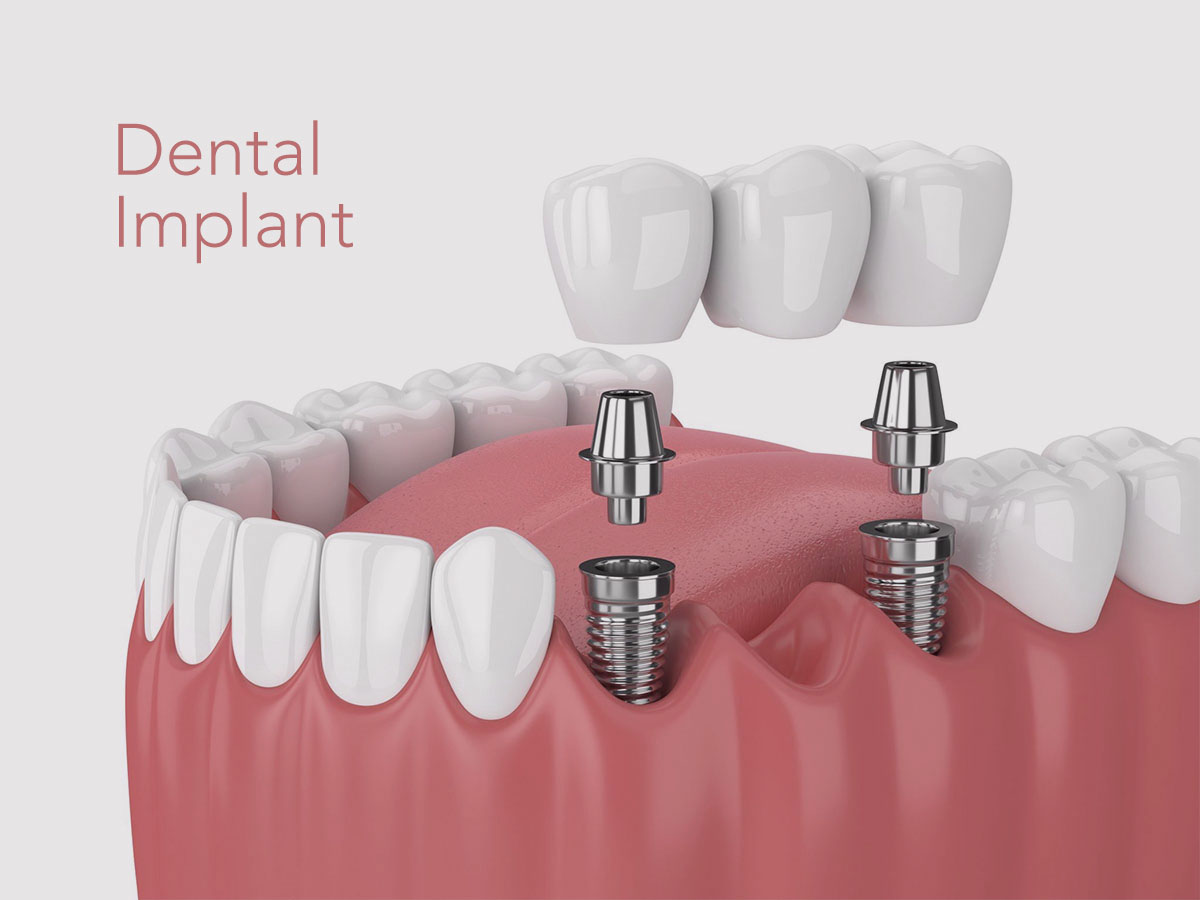 Dental Implant Cost